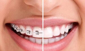 Braces before and after smile.