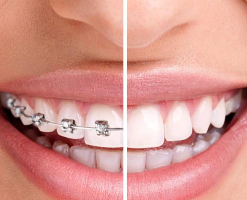 Braces before and after smile.