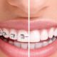 Braces before and after smile.