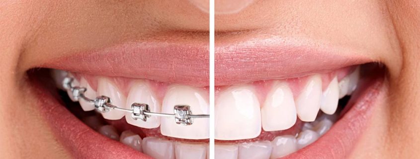 Braces before and after smile.