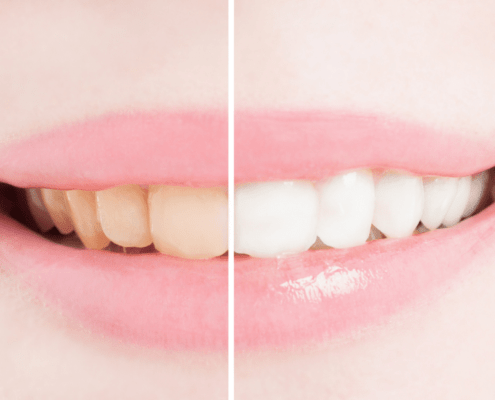 How Long Does It Take To Whiten Your Teeth