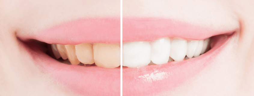 How Long Does It Take To Whiten Your Teeth