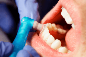 What a Dental Cleaning Involves: A Step-by-Step Guide to a Healthy Smile