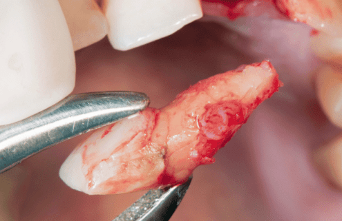 Common-Dental-Emergencies-and-First-Aid